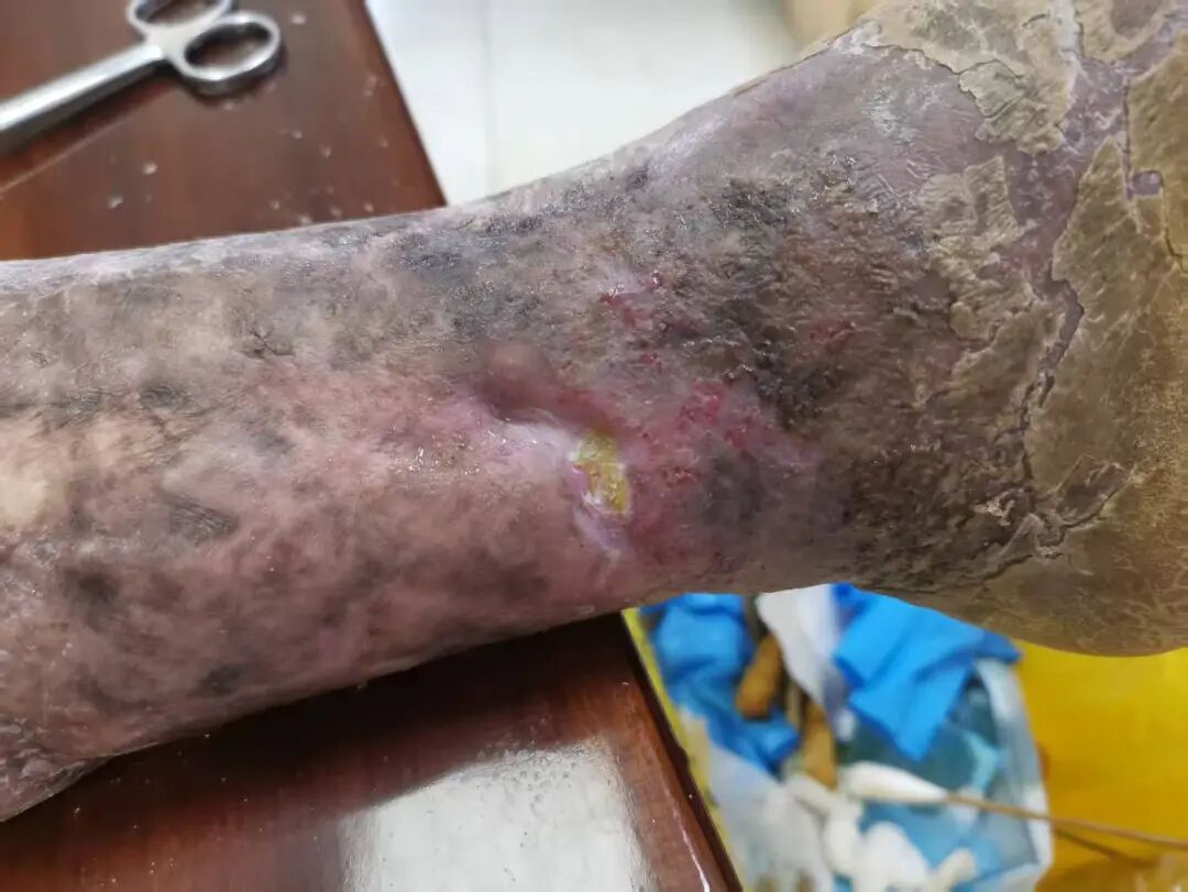 怎么促进vsd伤口愈合负压封闭引流术（VSD）：让伤口愈合更轻松_https://www.jmylbn.com_新闻资讯_第8张