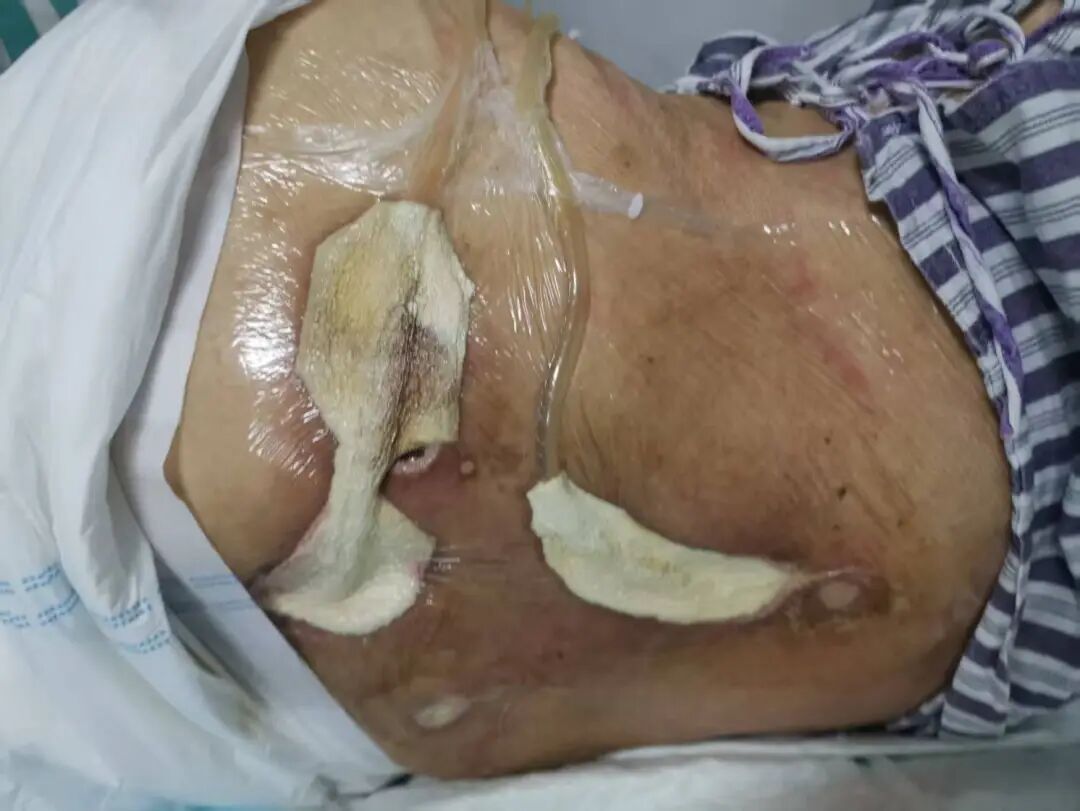 怎么促进vsd伤口愈合负压封闭引流术（VSD）：让伤口愈合更轻松_https://www.jmylbn.com_新闻资讯_第3张