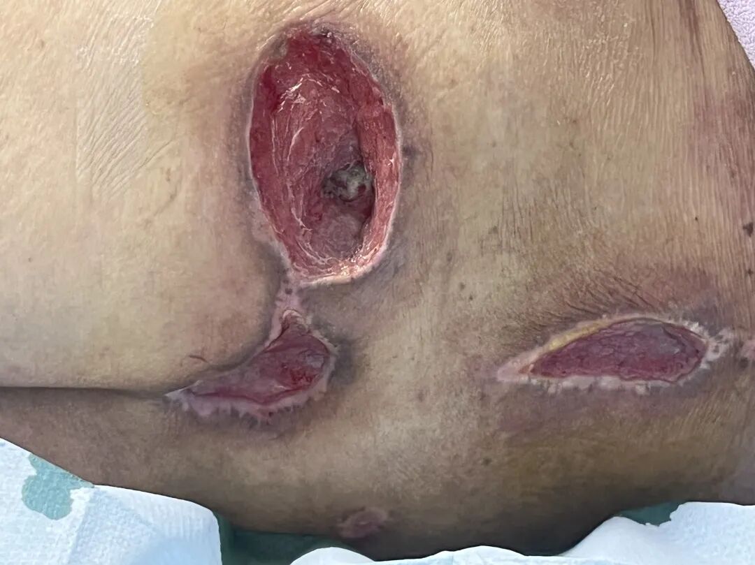 怎么促进vsd伤口愈合负压封闭引流术（VSD）：让伤口愈合更轻松_https://www.jmylbn.com_新闻资讯_第5张