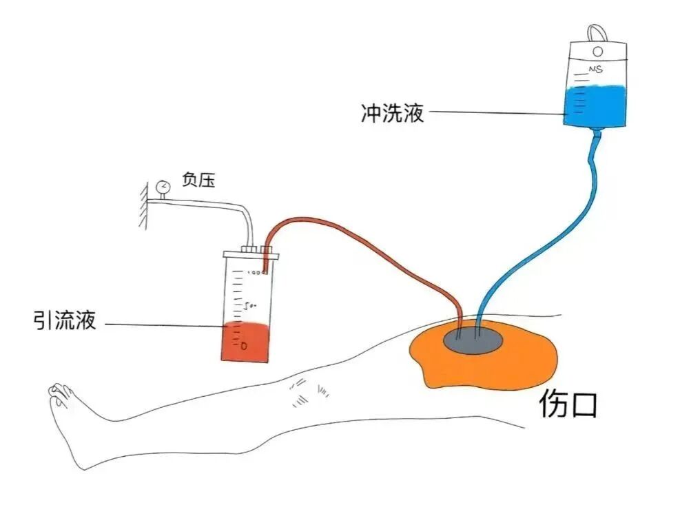 怎么促进vsd伤口愈合负压封闭引流术（VSD）：让伤口愈合更轻松_https://www.jmylbn.com_新闻资讯_第10张