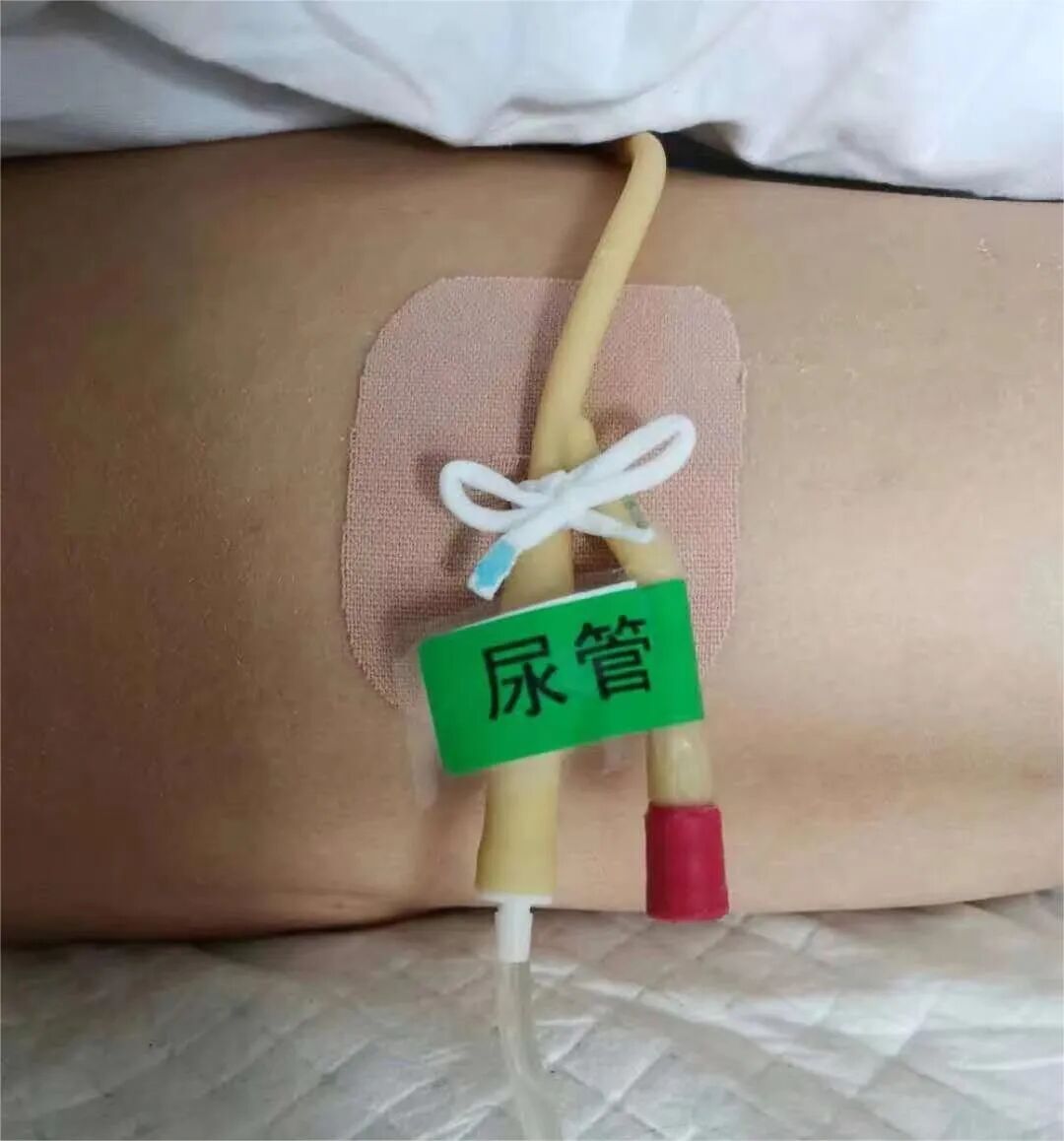为什么要引流尿袋【科普】留置尿管患者如何进行居家护理？_https://www.jmylbn.com_新闻资讯_第3张