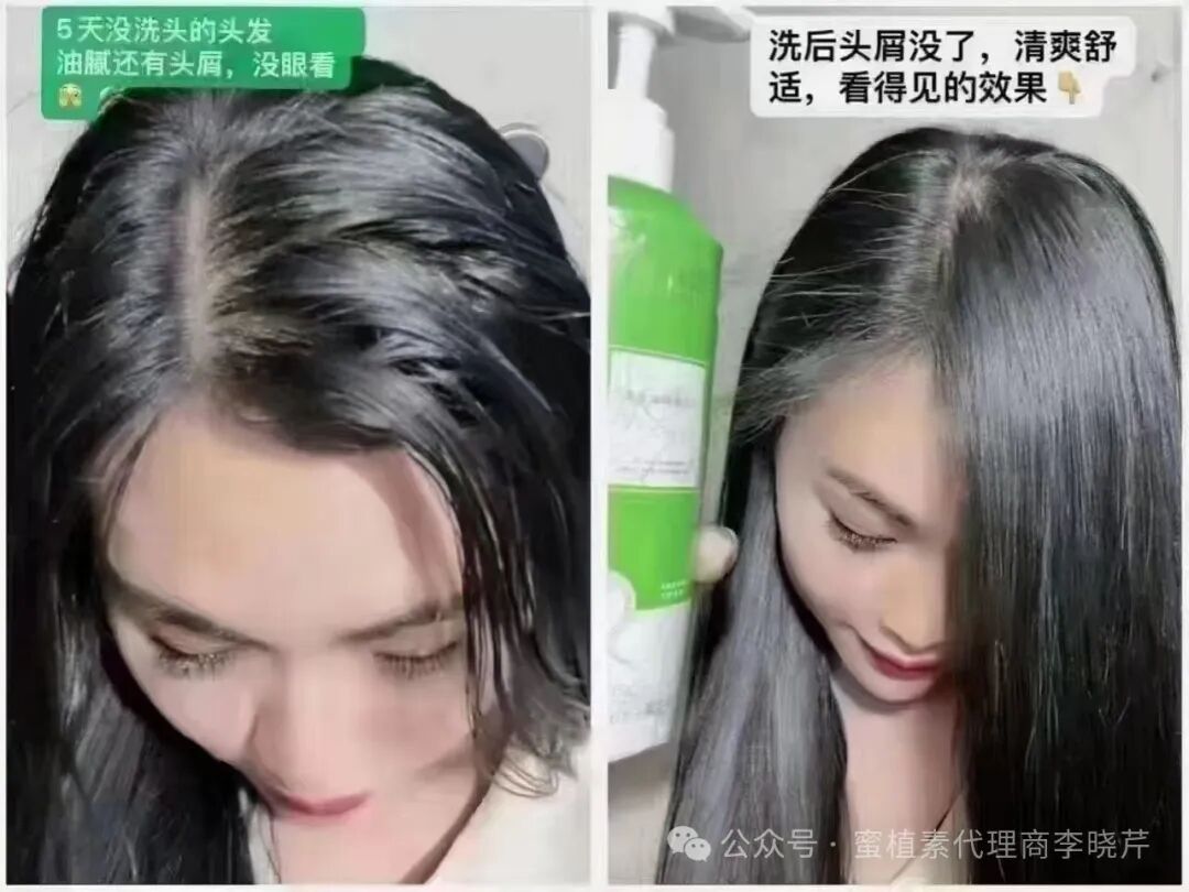 蜜植素洗发水好用吗？多少钱一套，有哪些功效呢？头屑，头痒，头油，脱发用什么洗发水比较好呢？