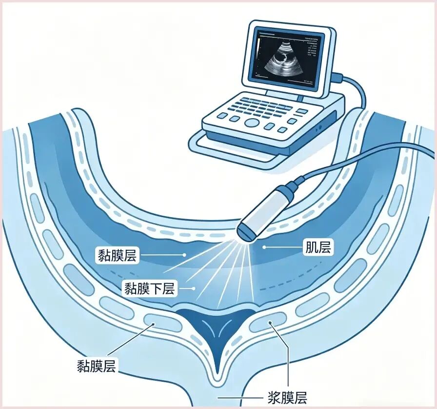 超声检查示意