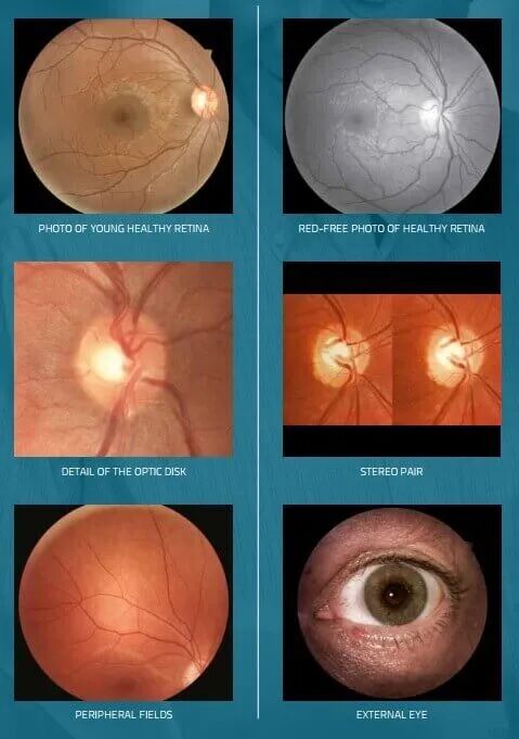 眼底照相机怎么项目介绍｜眼底照相_https://www.jmylbn.com_新闻资讯_第3张