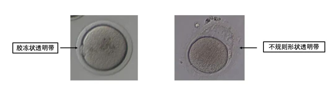 卵母细胞形态学异常对试管有什么影响?