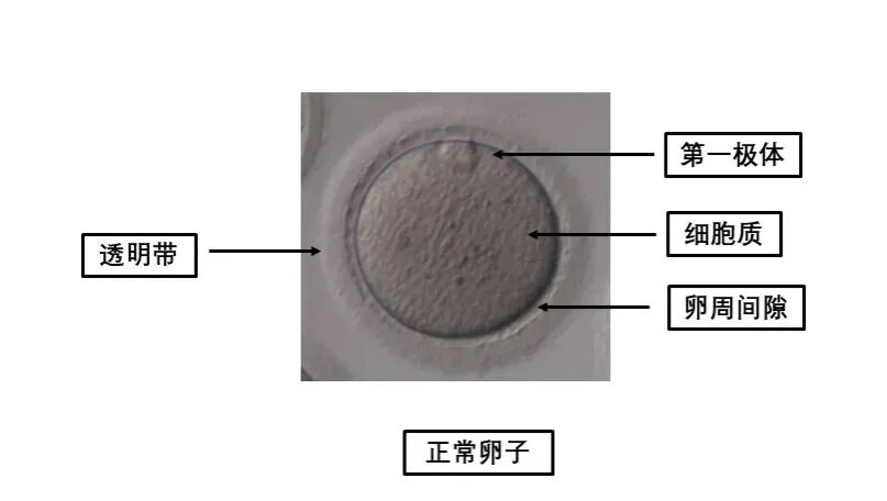 卵母细胞形态学异常对试管有什么影响?