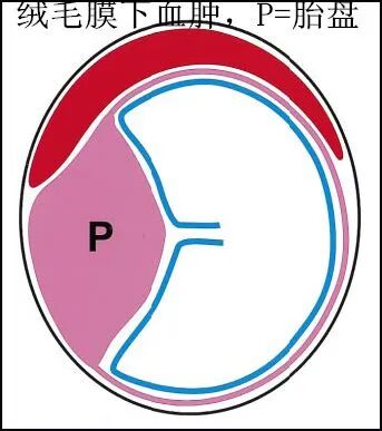 0%的流产都是它所致，孕早期要注意排查！"