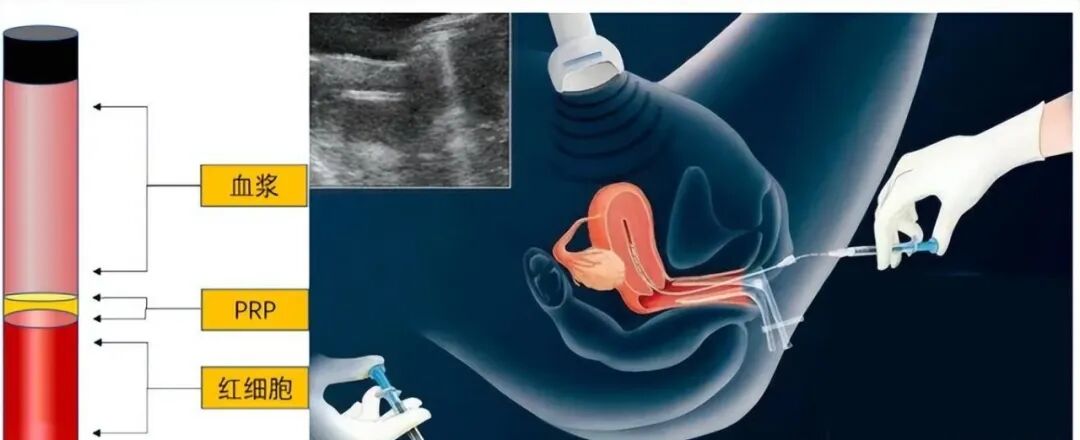 内膜薄？反复移植失败？试试这个“黑科技”！