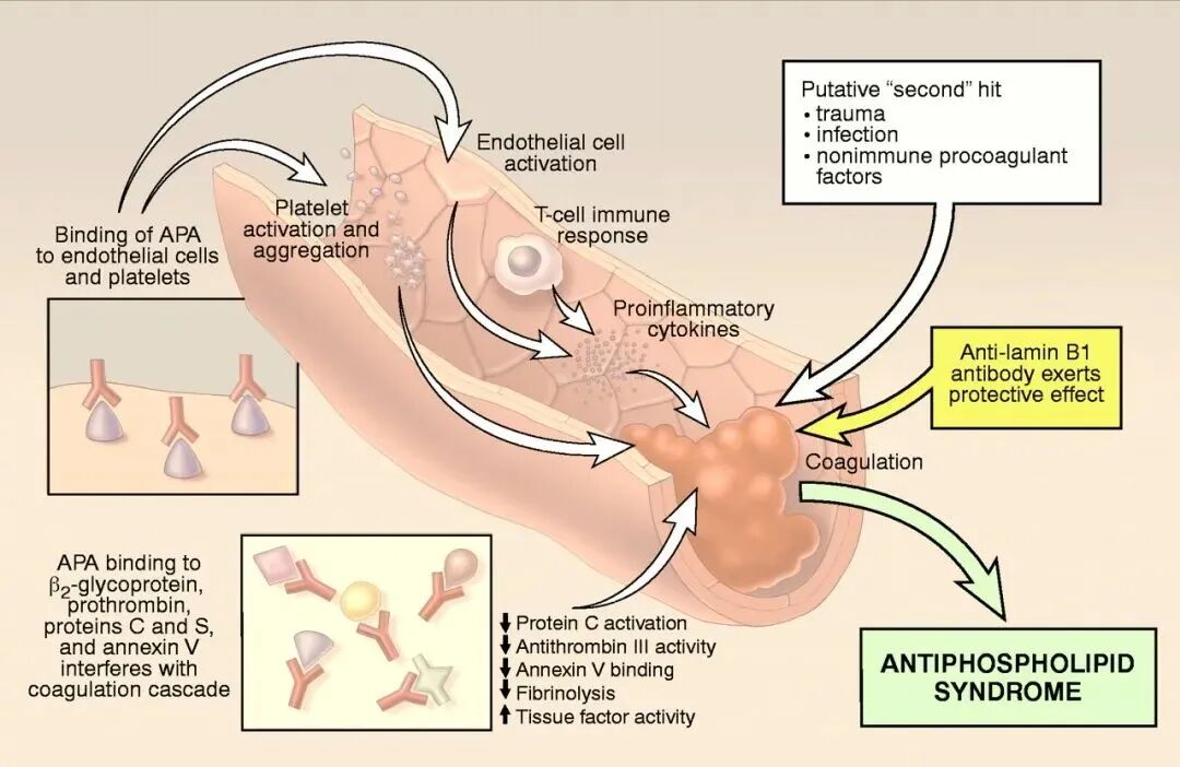 抗心磷脂抗体阳性对试管助孕有什么影响？
