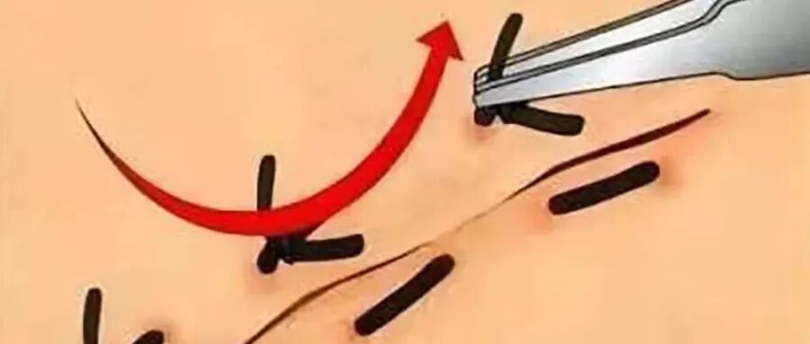 为什么手术用电刀手术中高频电刀的使用注意事项，保障手术安全！_https://www.jmylbn.com_新闻资讯_第19张