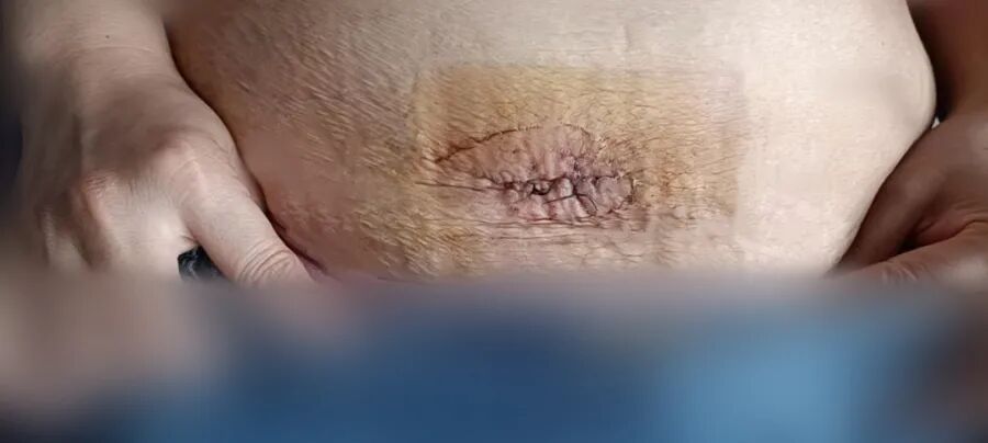 为什么负压引流【博爱骨科】VSD负压封闭引流技术普外科应用，让患者创面更快痊愈！_https://www.jmylbn.com_新闻资讯_第7张