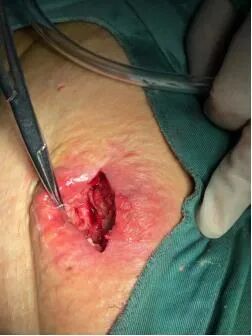 为什么负压引流【博爱骨科】VSD负压封闭引流技术普外科应用，让患者创面更快痊愈！_https://www.jmylbn.com_新闻资讯_第5张