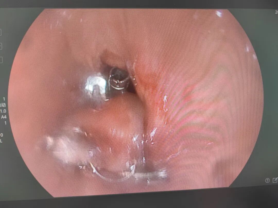 内镜夹怎么不掉食管瘘患者经口进食不是梦——我院消化内二科食管瘘内镜下吻合夹夹闭术一例!_https://www.jmylbn.com_新闻资讯_第3张
