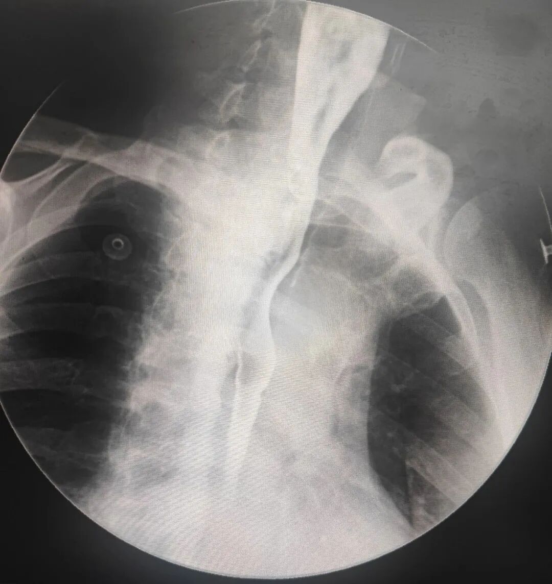 内镜夹怎么不掉食管瘘患者经口进食不是梦——我院消化内二科食管瘘内镜下吻合夹夹闭术一例!_https://www.jmylbn.com_新闻资讯_第4张