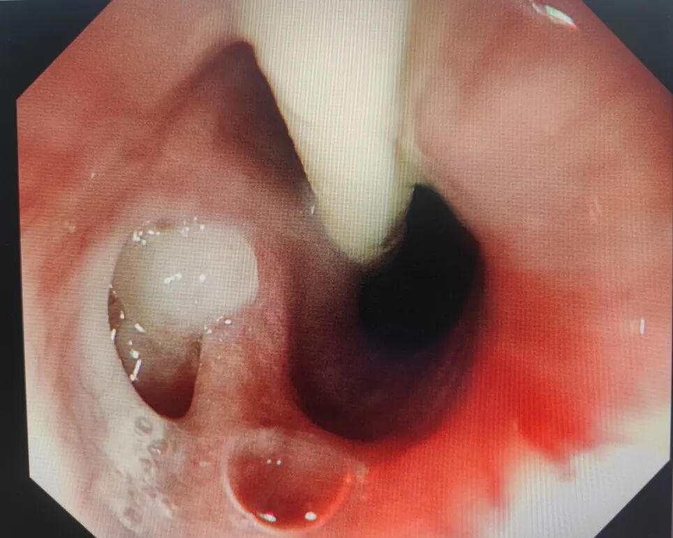 内镜夹怎么不掉食管瘘患者经口进食不是梦——我院消化内二科食管瘘内镜下吻合夹夹闭术一例!_https://www.jmylbn.com_新闻资讯_第2张