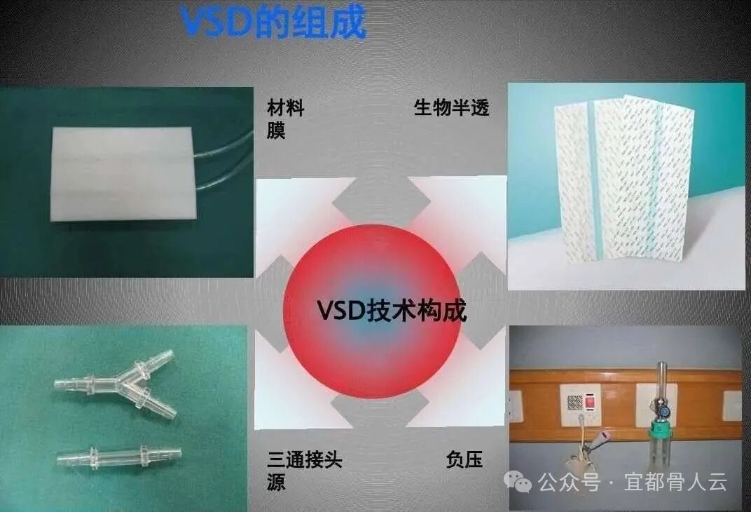什么是vsd负压引流负压封闭引流术以下内容要知熟_https://www.jmylbn.com_新闻资讯_第5张