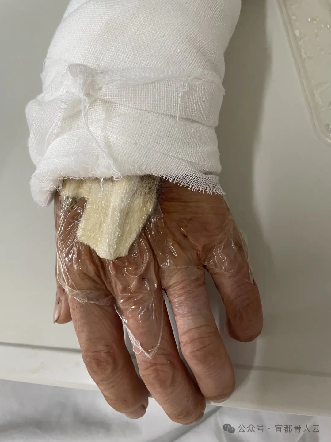 什么是vsd负压引流负压封闭引流术以下内容要知熟_https://www.jmylbn.com_新闻资讯_第9张