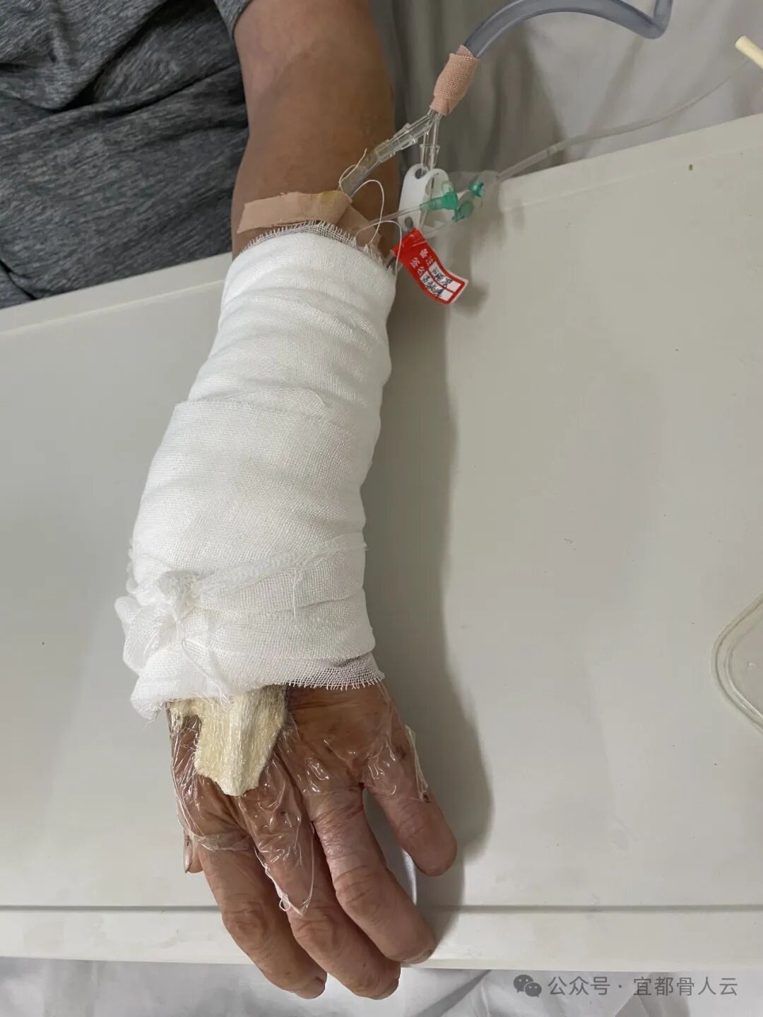 什么是vsd负压引流负压封闭引流术以下内容要知熟_https://www.jmylbn.com_新闻资讯_第10张