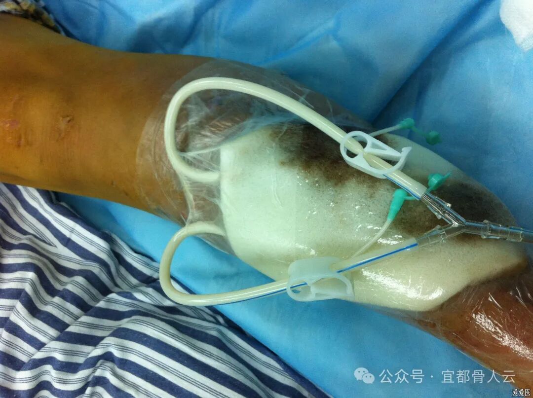 什么是vsd负压引流负压封闭引流术以下内容要知熟_https://www.jmylbn.com_新闻资讯_第16张