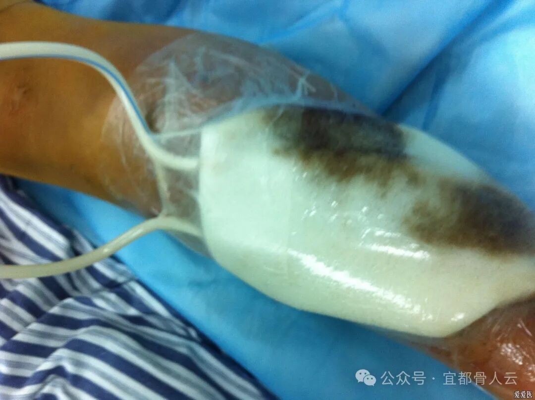 什么是vsd负压引流负压封闭引流术以下内容要知熟_https://www.jmylbn.com_新闻资讯_第17张