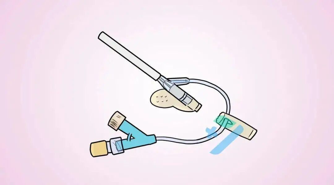 为什么要用泵打针手术室打的留置针，“针”有讲究？_https://www.jmylbn.com_新闻资讯_第2张