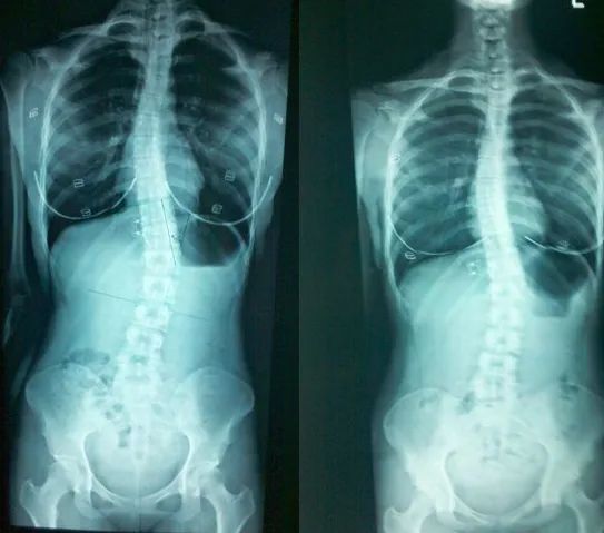 彎 脊柱 症 側 脊柱側彎症之治療 通論
