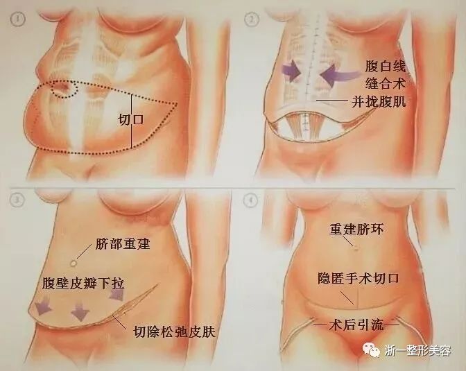 腹壁整形——从此告别“大肚腩”