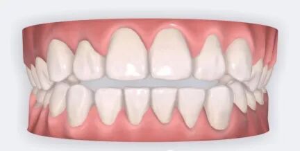 乐凯医疗怎么样矫正牙齿 重塑美丽｜乐凯医院口腔科已开展正畸治疗技术_https://www.jmylbn.com_新闻资讯_第14张