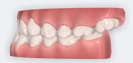 乐凯医疗怎么样矫正牙齿 重塑美丽｜乐凯医院口腔科已开展正畸治疗技术_https://www.jmylbn.com_新闻资讯_第11张