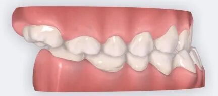 乐凯医疗怎么样矫正牙齿 重塑美丽｜乐凯医院口腔科已开展正畸治疗技术_https://www.jmylbn.com_新闻资讯_第13张