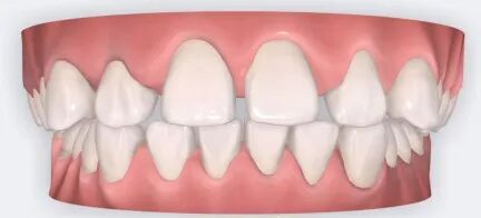 乐凯医疗怎么样矫正牙齿 重塑美丽｜乐凯医院口腔科已开展正畸治疗技术_https://www.jmylbn.com_新闻资讯_第7张