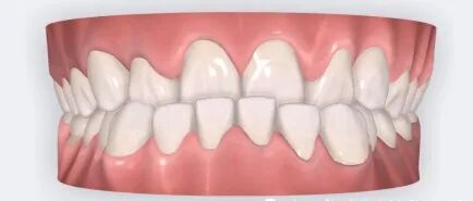 乐凯医疗怎么样矫正牙齿 重塑美丽｜乐凯医院口腔科已开展正畸治疗技术_https://www.jmylbn.com_新闻资讯_第12张