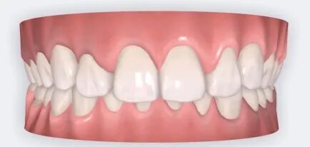 乐凯医疗怎么样矫正牙齿 重塑美丽｜乐凯医院口腔科已开展正畸治疗技术_https://www.jmylbn.com_新闻资讯_第8张