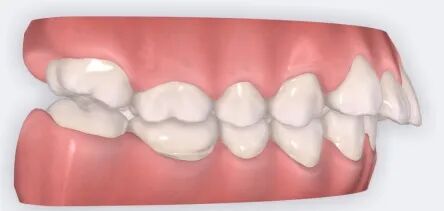 乐凯医疗怎么样矫正牙齿 重塑美丽｜乐凯医院口腔科已开展正畸治疗技术_https://www.jmylbn.com_新闻资讯_第10张