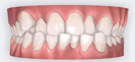 乐凯医疗怎么样矫正牙齿 重塑美丽｜乐凯医院口腔科已开展正畸治疗技术_https://www.jmylbn.com_新闻资讯_第6张