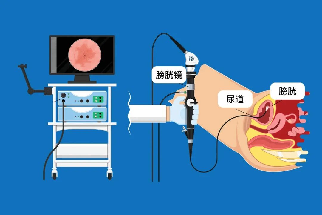 b膀胱镜为什么消毒什么是膀胱镜检查？_https://www.jmylbn.com_新闻资讯_第5张