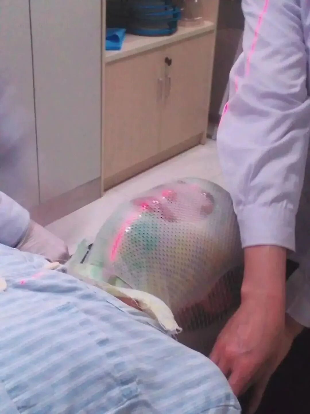 放疗体膜是什么全脑全脊髓放疗时的体位固定技巧_https://www.jmylbn.com_新闻资讯_第8张