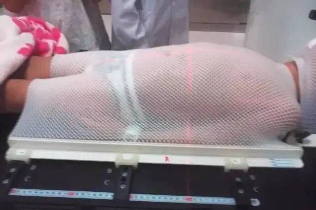 放疗体膜是什么全脑全脊髓放疗时的体位固定技巧_https://www.jmylbn.com_新闻资讯_第13张