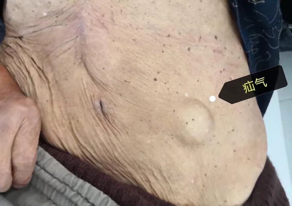 为何老年人更易遭遇疝气困扰?