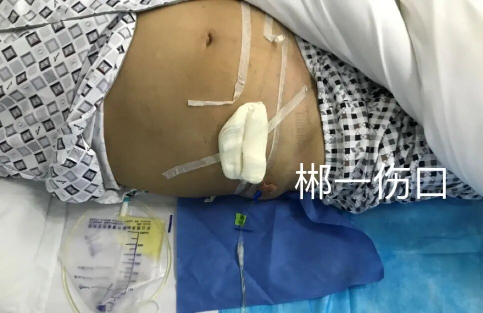 什么是引流口敷料腹腔引流管口渗漏 该咋办？-上海聚慕医疗器械有限公司
