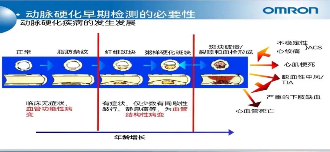 动脉硬化检测仪怎么用【科普】新科技仪器引进，血管阻塞？血管僵硬？动脉硬化检测让你一目了然_https://www.jmylbn.com_新闻资讯_第2张