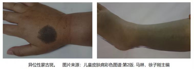 痣的图.png
