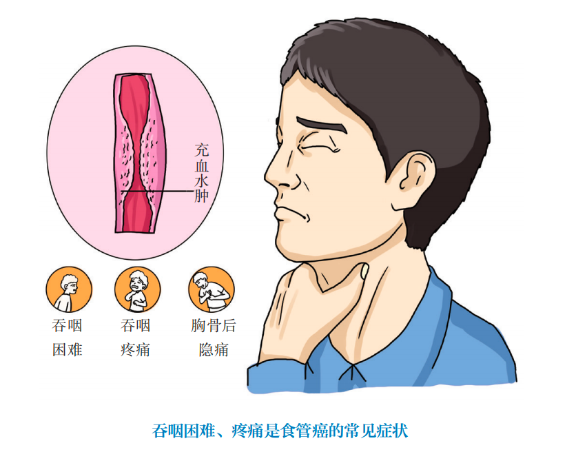 吃出來的癌症喉嚨出現這4種症狀可能是食道癌預警