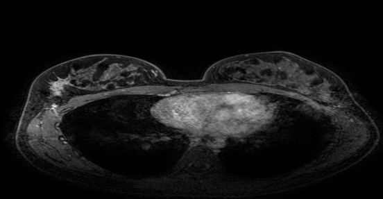 乳腺cr是什么双优标杆！从PD到18 个月达颅内CR，瑞波西利改写32岁HR+／HER2-晚期乳腺癌患者命运_https://www.jmylbn.com_新闻资讯_第5张