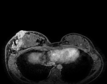乳腺cr是什么双优标杆！从PD到18 个月达颅内CR，瑞波西利改写32岁HR+／HER2-晚期乳腺癌患者命运_https://www.jmylbn.com_新闻资讯_第2张