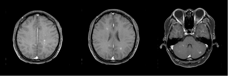 乳腺cr是什么双优标杆！从PD到18 个月达颅内CR，瑞波西利改写32岁HR+／HER2-晚期乳腺癌患者命运_https://www.jmylbn.com_新闻资讯_第6张