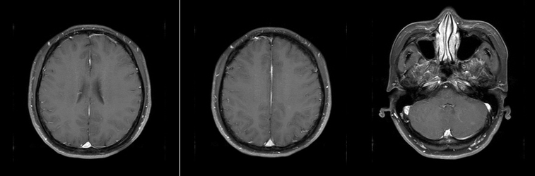 乳腺cr是什么双优标杆！从PD到18 个月达颅内CR，瑞波西利改写32岁HR+／HER2-晚期乳腺癌患者命运_https://www.jmylbn.com_新闻资讯_第7张