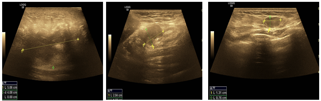 乳腺cr是什么双优标杆！从PD到18 个月达颅内CR，瑞波西利改写32岁HR+／HER2-晚期乳腺癌患者命运_https://www.jmylbn.com_新闻资讯_第1张