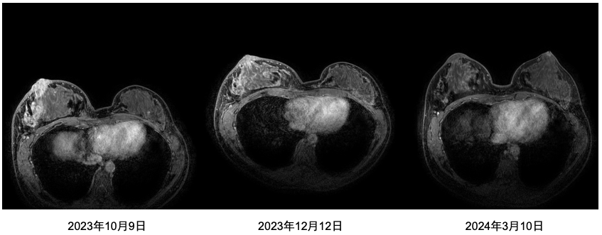 乳腺cr是什么双优标杆！从PD到18 个月达颅内CR，瑞波西利改写32岁HR+／HER2-晚期乳腺癌患者命运_https://www.jmylbn.com_新闻资讯_第4张