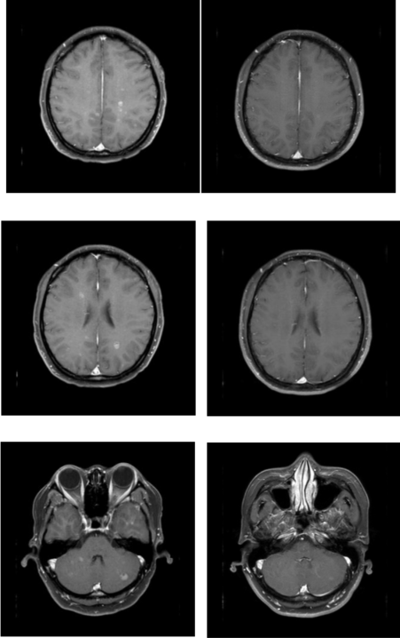 乳腺cr是什么双优标杆！从PD到18 个月达颅内CR，瑞波西利改写32岁HR+／HER2-晚期乳腺癌患者命运_https://www.jmylbn.com_新闻资讯_第9张